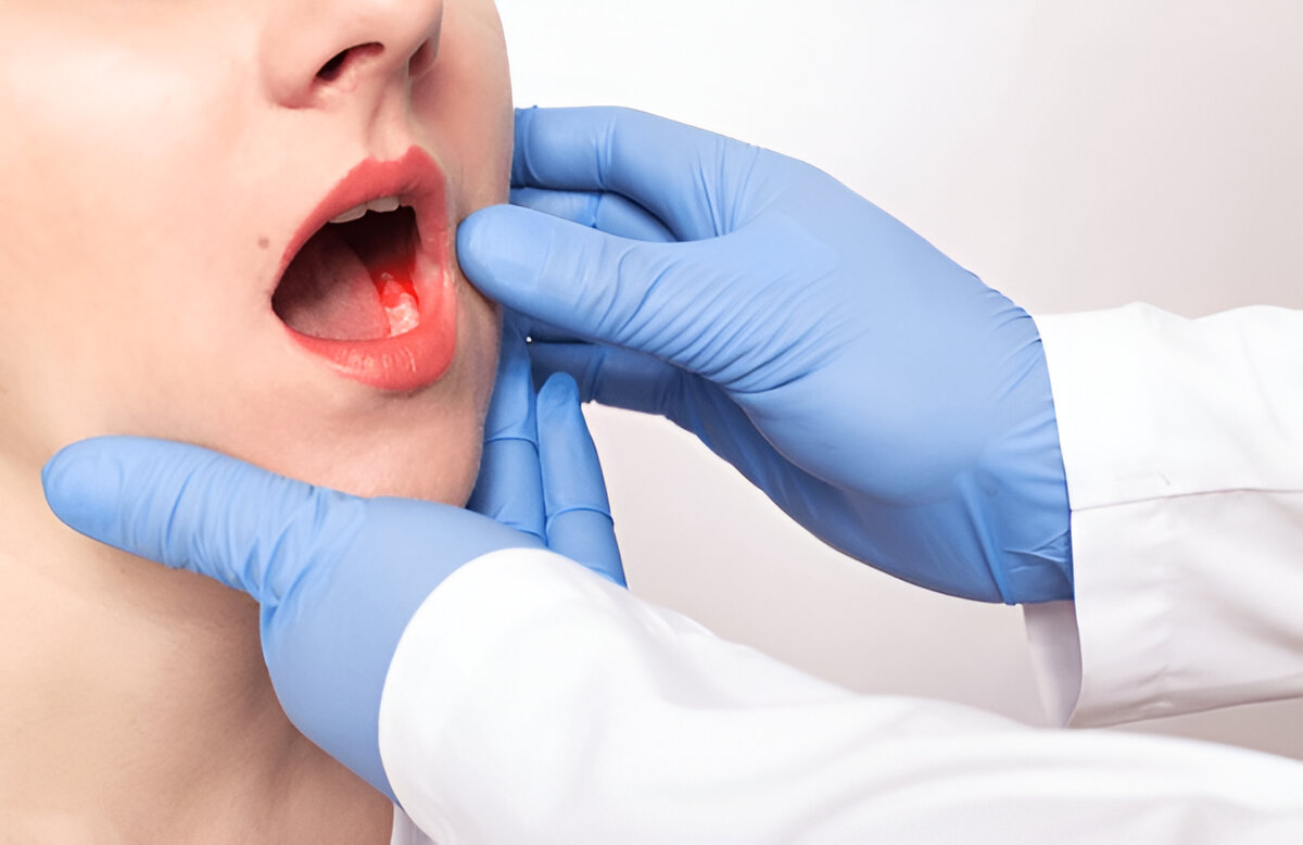 Mouth Cancer in Bhilwara