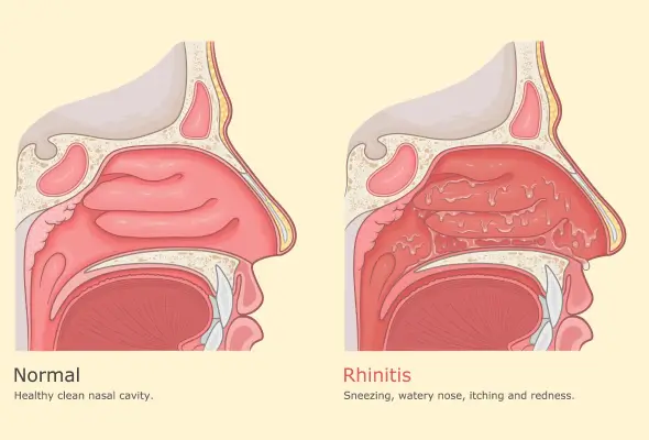 ENT Specialist in Ahmedabad Treats Chronic Rhinitis